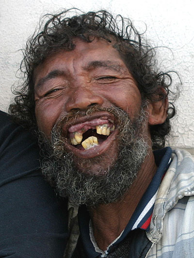 girls with rotten teeth